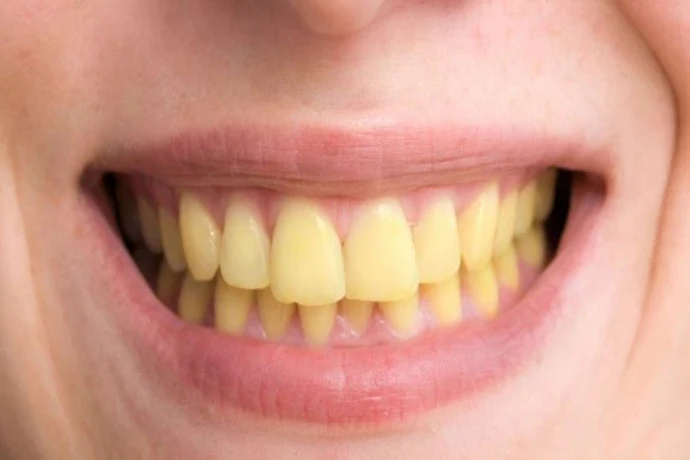 Atténuer les dents jaunes : solutions et conseils