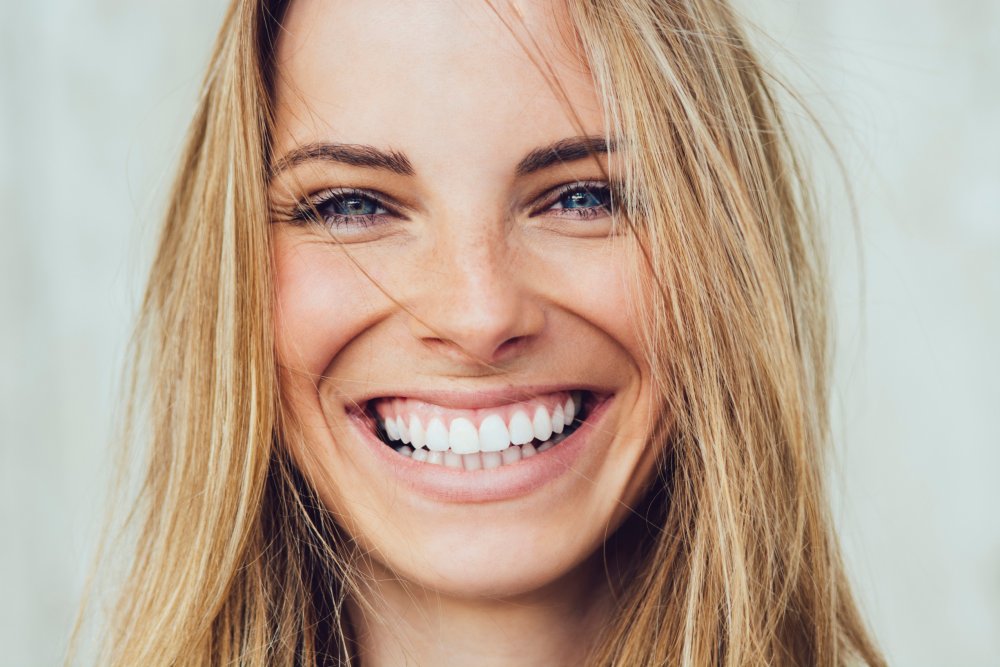 Un sourire remodelé grâce aux facettes céramiques